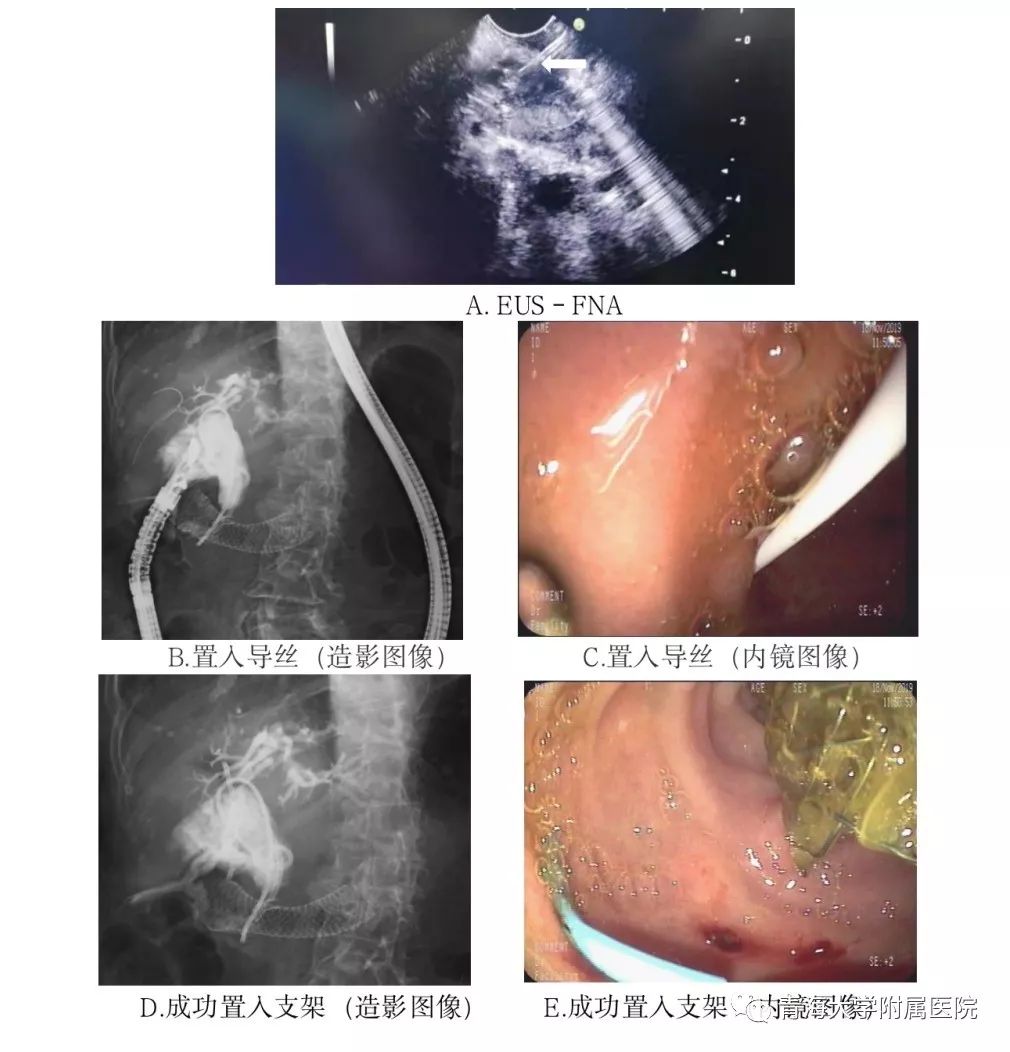 bd医疗怎么样超声内镜引导下胆汁引流术（EUS-BD）——开启青海大学附属医院内镜微创治疗新天地