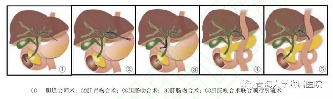bd医疗怎么样超声内镜引导下胆汁引流术（EUS-BD）——开启青海大学附属医院内镜微创治疗新天地