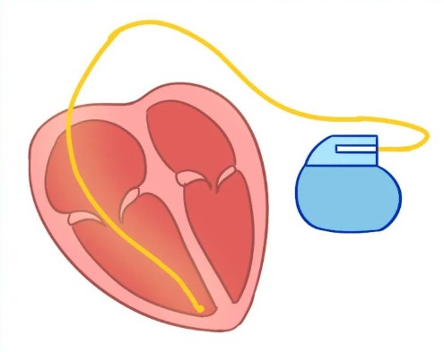 单腔、双腔、三腔临时心脏起搏器，腔越多越好吗？