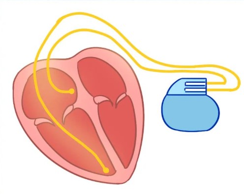 单腔、双腔、三腔临时心脏起搏器，腔越多越好吗？
