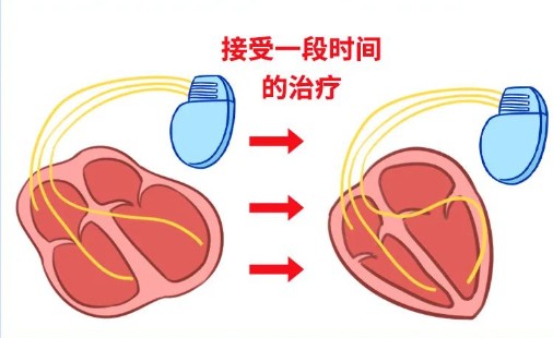 单腔、双腔、三腔临时心脏起搏器，腔越多越好吗？